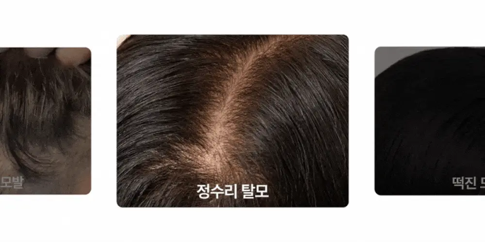 [5종임상완료/4주탈모케어] 애쉬로렌 맥주효모 바이탈 스칼프 앰플 100ml 상세페이지 4